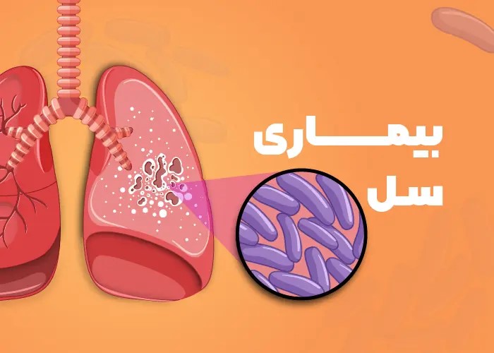 بیماری سل